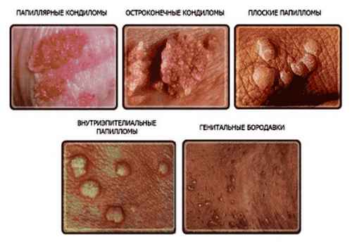 Все найважливіше про вірус папіломи людини (ВПЛ)
