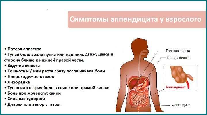 Перші ознаки і симптоми апендициту у жінок, чоловіків, у підлітка і дитини