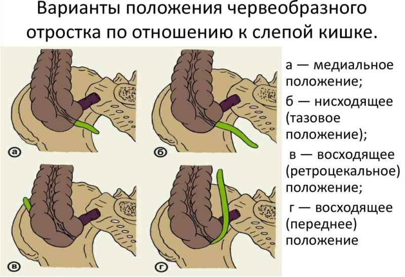 Перші ознаки і симптоми апендициту у жінок, чоловіків, у підлітка і дитини