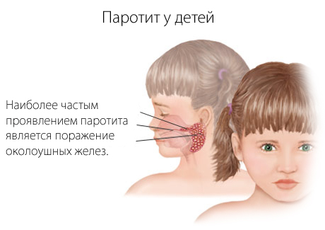 Паротит - що це за хвороба, симптоми і наслідки свинки у дорослих і дітей