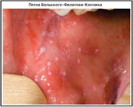 Ознаки, симптоми кору у дитини, що за хвороба, лікування, профілактика