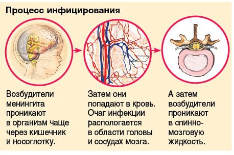 Симптоми менінгіту у дорослого, перші ознаки, діагностика та лікування