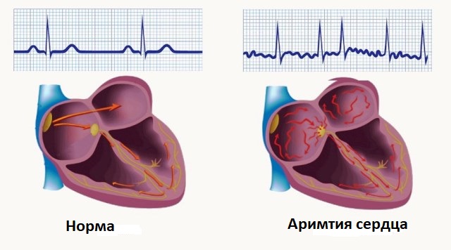 Нічна аритмія