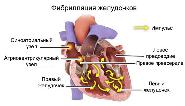 Нічна аритмія