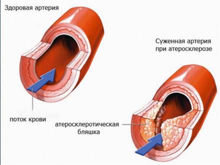 Стенозуючий атеросклероз нижніх кінцівок